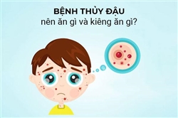 Lời khuyên bác sĩ về bệnh thủy đậu kiêng những gì?